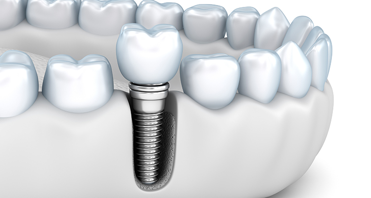 インプラントとは