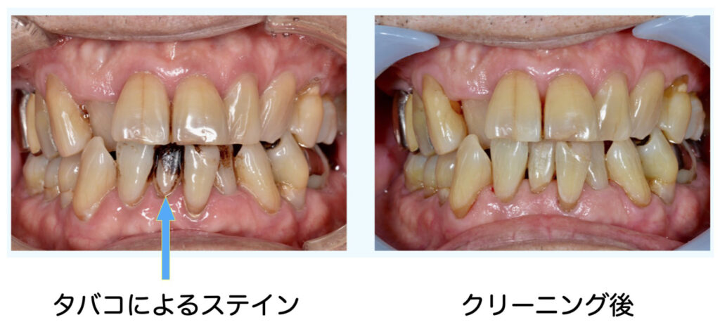 ステインを除去した症例