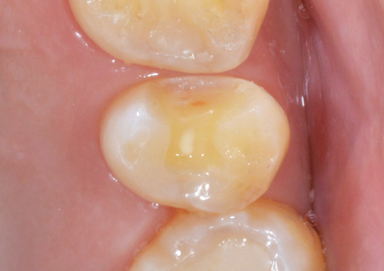 セラミックインレー