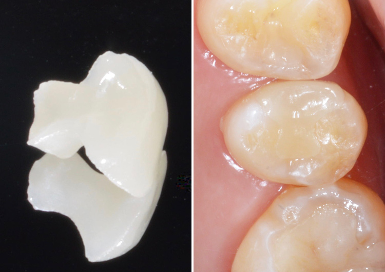 セラミックインレー