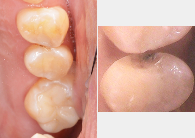 セラミックインレー