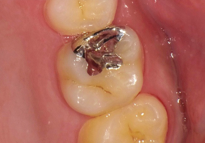 メタルインレー