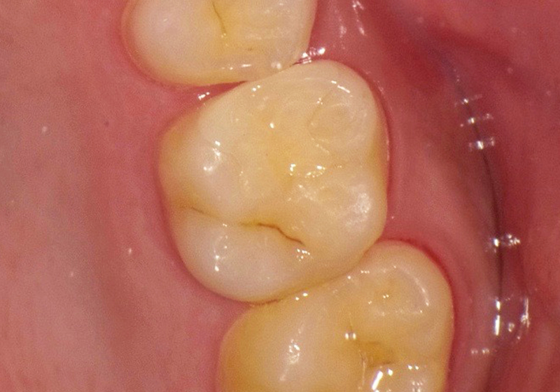 セラミックインレー