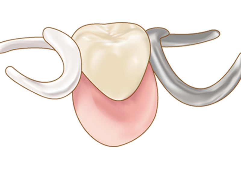 部分入れ歯