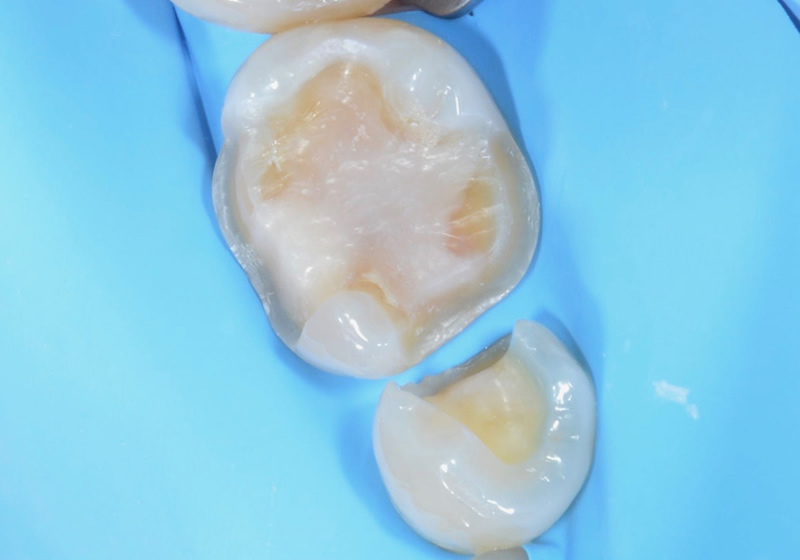 ラバーダム防湿