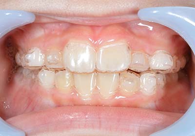 インビザラインファースト1