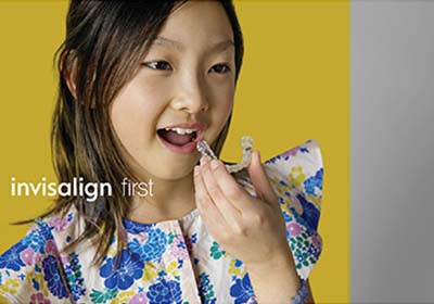 インビザラインファースト2