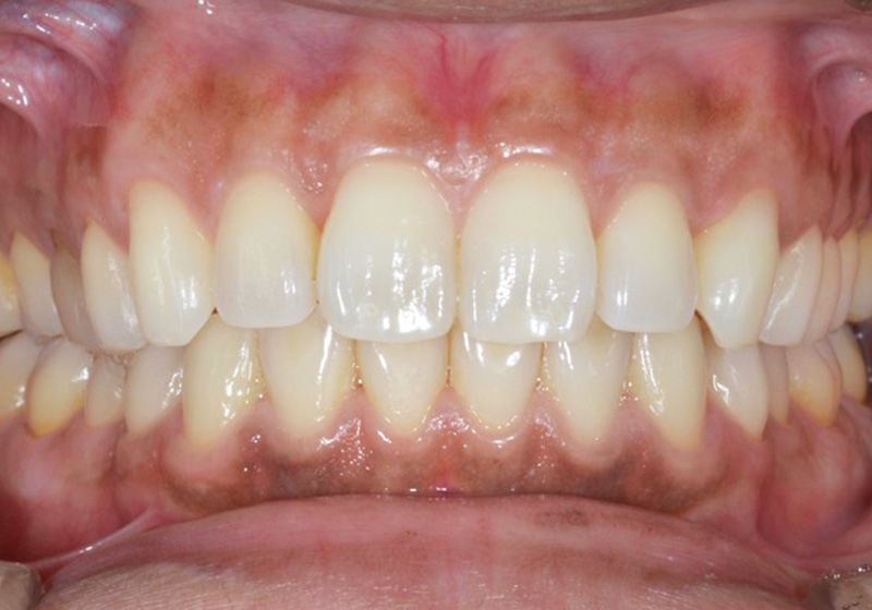 ホワイトニングトレーとジェルの写真