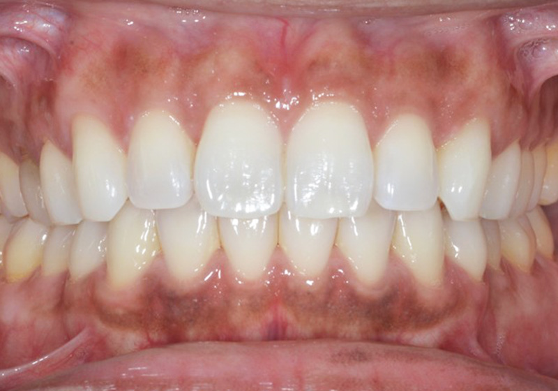 ホワイトニングトレーにジェルを入れている写真