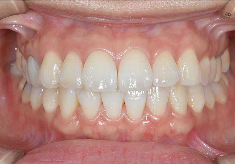 健康な歯ぐきの特徴